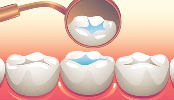 how long do dental sealants last | dental sealants Houston